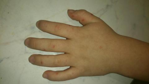 Отслаивание ногтей у ребенка после ангины
