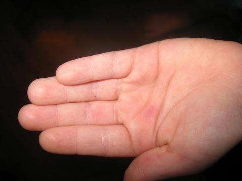 У ребенка слазят ногти после ветрянки может ли такое быть