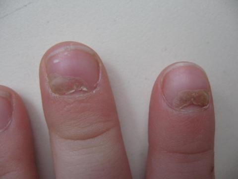 Отслаивание ногтей у ребенка после ангины